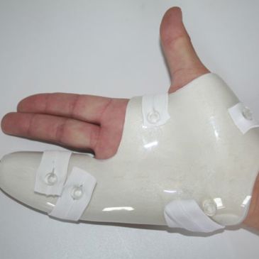 Depuytren vingerspalk