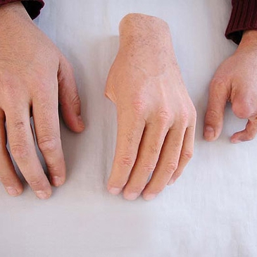 Cosmetische handprothese